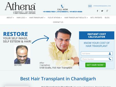 Best Hair Transplants in Chandigarh